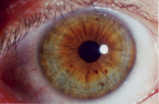 iridology eye sick person