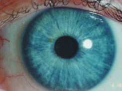 iridology eye sick person